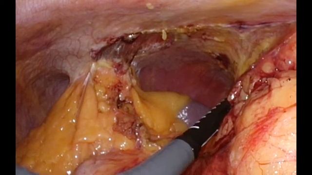 Лапароскопическая ультразвуковая диагностика рака почки смотреть онлайн