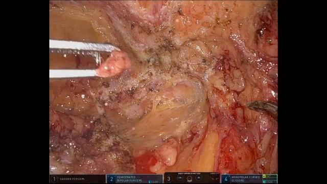 Robotic repair of re recurrent right inguinal смотреть онлайн