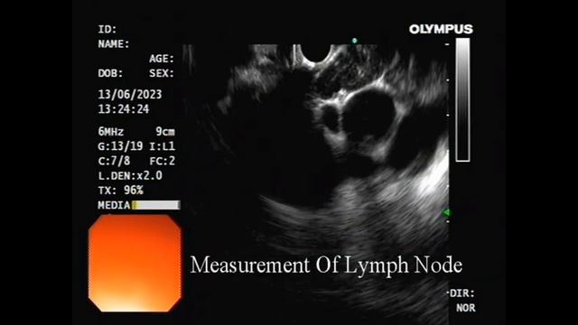 Laser Ablation of Mediastinal Lymph Nodes by EUS смотреть онлайн