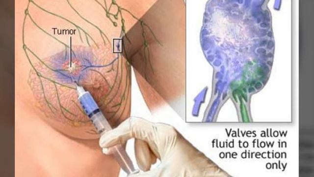 Sentinel lymph node biopsy смотреть онлайн