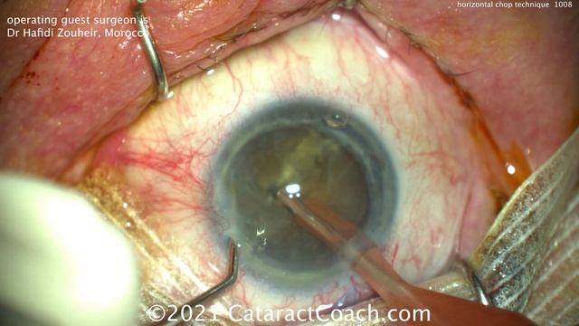 CataractCoach 1008: horizontal chop technique with dense white and brunescent cataracts смотреть онлайн