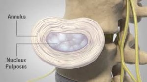 Discectomy   Patient Education