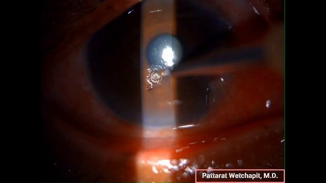 How to remove the metallic embedded foreign body from the cornea by rust ring remover. смотреть онлайн