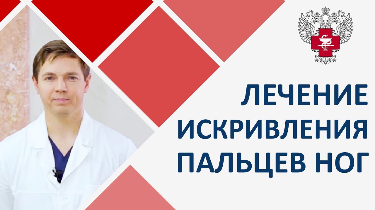 Как лечат вальгусную деформацию пальцев ног. Вальгусная деформация пальцев ног смотреть онлайн