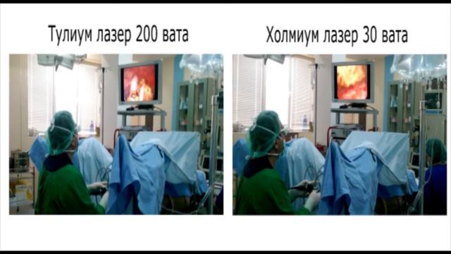 Разбиване на камък в пикочен мехур с 2 лазерни системи - Тулиум и Холмиум смотреть онлайн