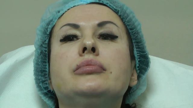 Какой филлер выбрать и как он себя поведёт в разных зонах при FULL FACE коррекции. Dr.Valeriy Potiy смотреть онлайн