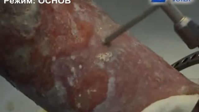 Ультразвуковая обработка гнойной раны смотреть онлайн