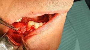 НКР нижняя челюсть.