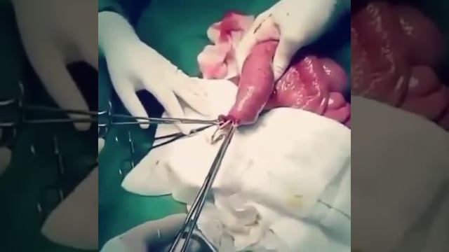 Извлечение аскарид из кишечника