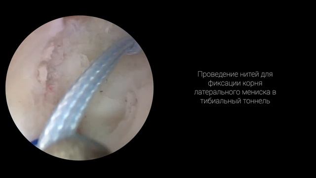 Шов ПКС, обоих менисков, фиксация корня латерального мениска смотреть онлайн
