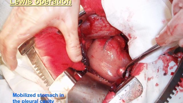 9:50 РАК ЖИЛУДКА И РАК ПИЩЕВОДА (ESOPHAGEAL CANCER) смотреть онлайн
