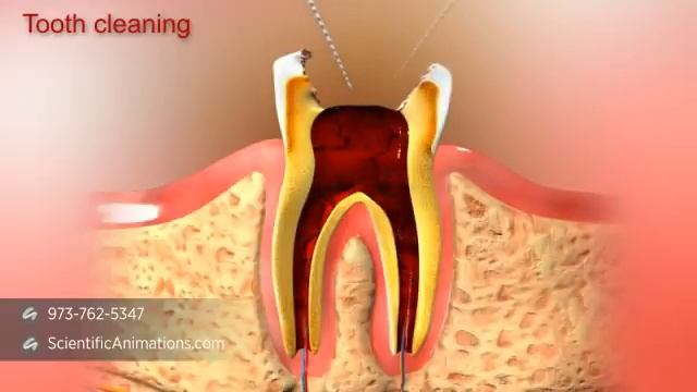 Root Canal Treatment