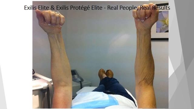 EXILIS ELITE - фото До и ПОСЛЕ смотреть онлайн