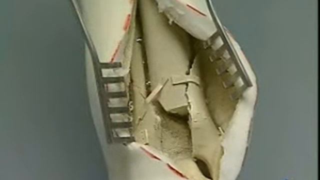 Pilon Tibial #