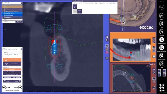 INSIGHTS 2018: Exoplan Case Demonstration - Planning Of Implants And Design Of A Surgical Guide
