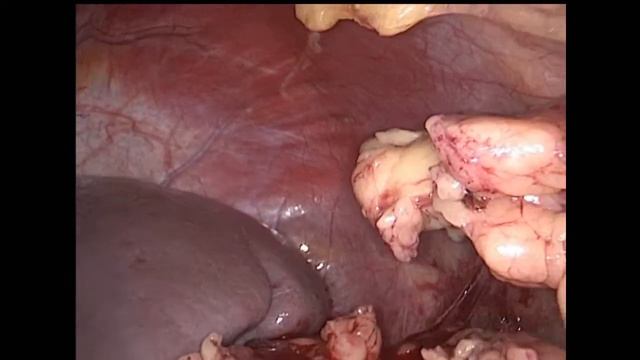 25.01.2022 Laparoscopic Left Partial Nephrectomy / Лапароскопическая резекция левой почки смотреть онлайн