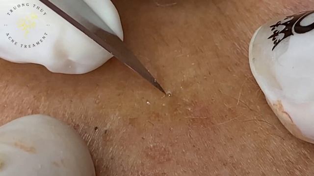 Acne Treament Under The Skin #029 смотреть онлайн