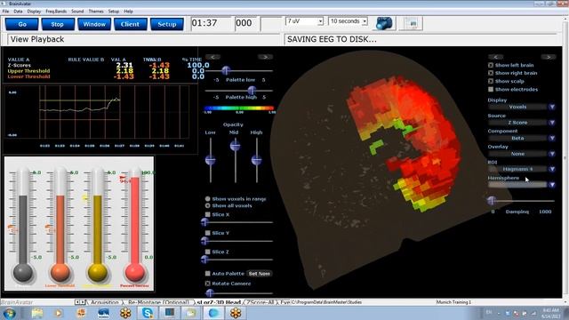 BrainAvatar BrainDX sLORETA Z Scores смотреть онлайн