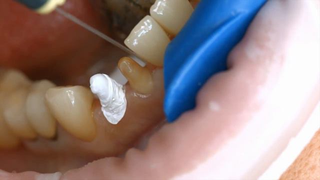 Variolink+Esthetic Monobond+Plus+ +Cementation+of+crowns+made+of+IPS+e max+Press смотреть онлайн