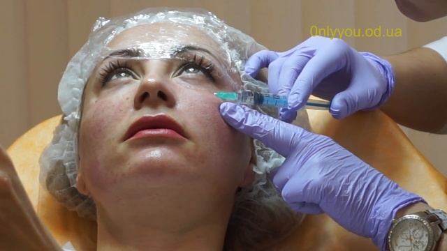 Мезотерапия