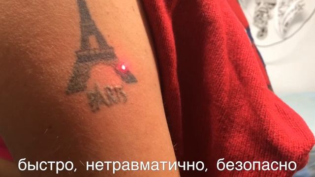 Удаление небольшой татуировки неодимовым лазером в СПб смотреть онлайн