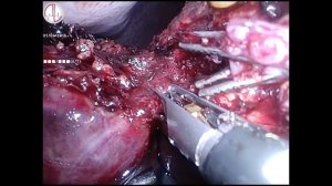 Лапароскопическая резекция печени