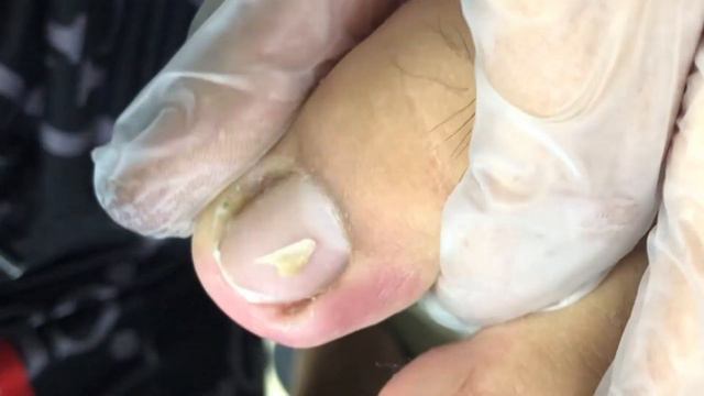 Paronychia Inflammation in the long flesh, the pedicure master treats it【Foot Scalpel】 смотреть онлайн
