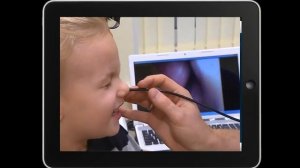 Аденоиды у детей.