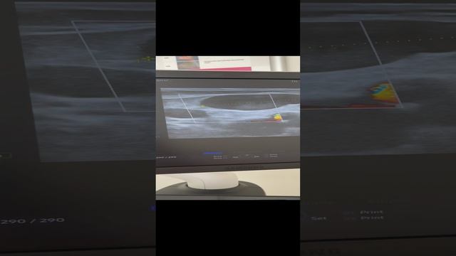 Огромные варикозные узлы на узи. Узи вен. Флеболог Москва смотреть онлайн