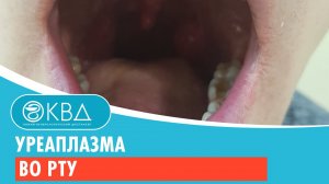 ? Уреаплазма во рту. Клинический случай №297