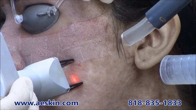Fractional CO2 Demonstration 3 - A E Skin - Encino, CA - 818-835-1833 смотреть онлайн