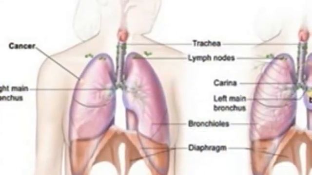 Understanding Lung Cancer, Part III: Staging смотреть онлайн