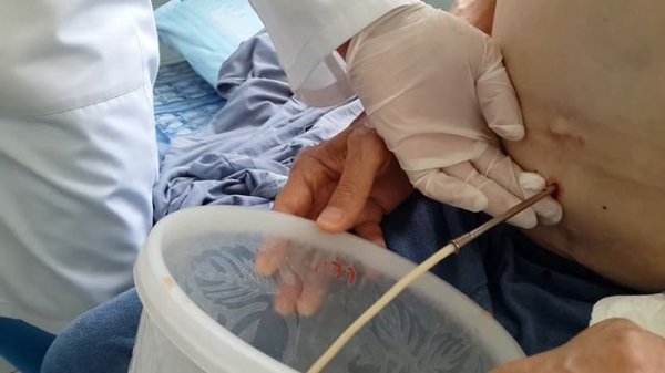 Лапароцентез 09