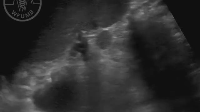 WFUMB Course Book: Basics Of Ultrasound Examination Of Spleen And Lymph Nodes CH9 -Video 9.5