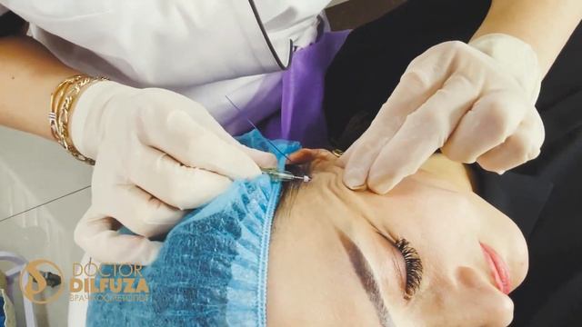 Yuzga niti qo'yish- Doctor Dilfuza| Нити на лицо| Doctor Dilfuza смотреть онлайн