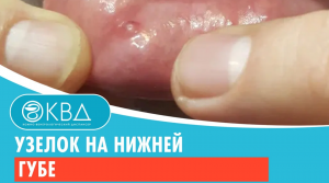 ? Узелок на нижней губе. Клинический случай №744