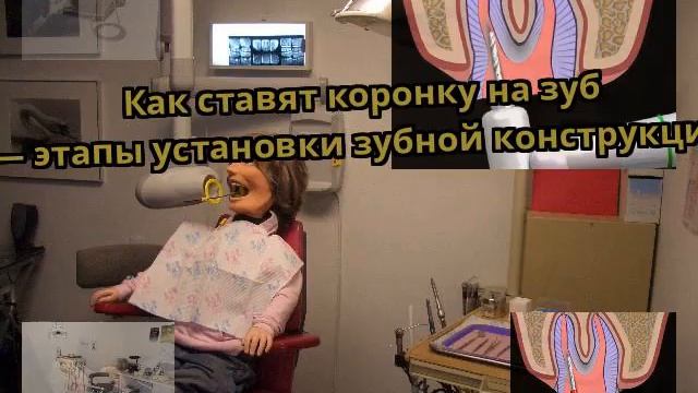 Как ставят коронку на зуб — этапы установки зубной конструкции