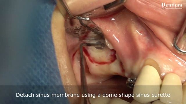 Short & Narrow implantation with sinus elevation смотреть онлайн
