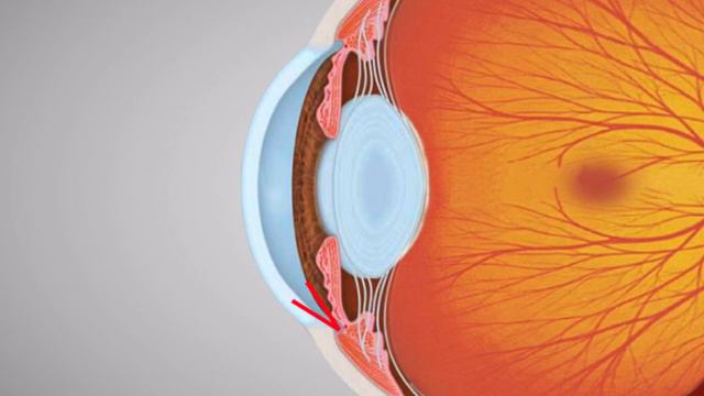 Glaucoma (Animation of Why It Happens and How It Can Cause Blindness) смотреть онлайн