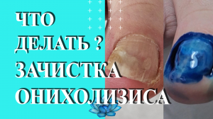 Онихолизис ногтей на ногах. Ноготь отходит от ногтевого ложа.
