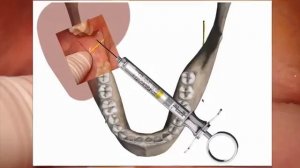 Местная анестезия в стоматологии. Мандибулярная анестезия