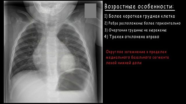 Рентген грудной клетки у детей. Очаговая пневмония. смотреть онлайн