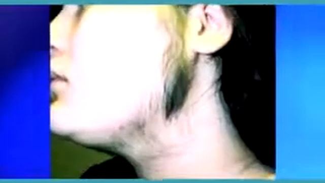 Candela Laser hair removal Vancouver WA gentlelase waitingroom смотреть онлайн