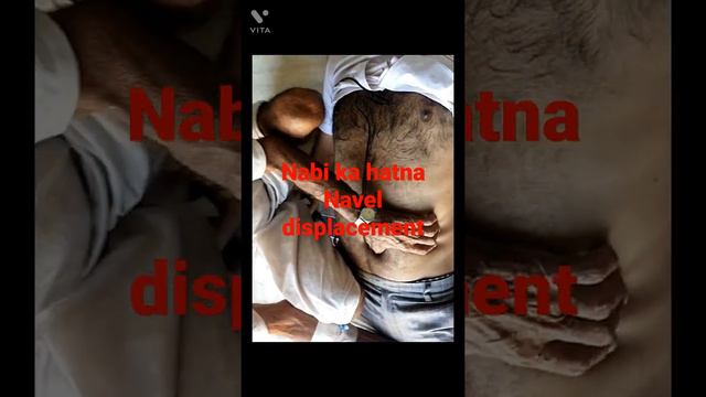 BACK PAIN .#NAVEL displacement смотреть онлайн