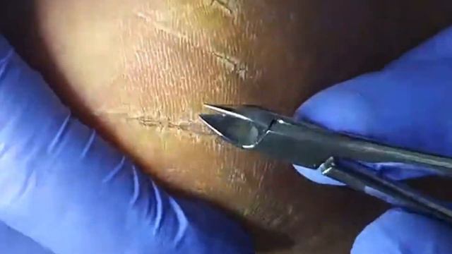 Сложная зачистка⚠️🆘🦶🏻 • Трещины👀❗️ • Часть 2