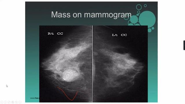 Procedure Of Mammogram & Other Imaging Procedure of breast смотреть онлайн