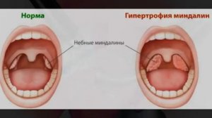 Удаление миндалин