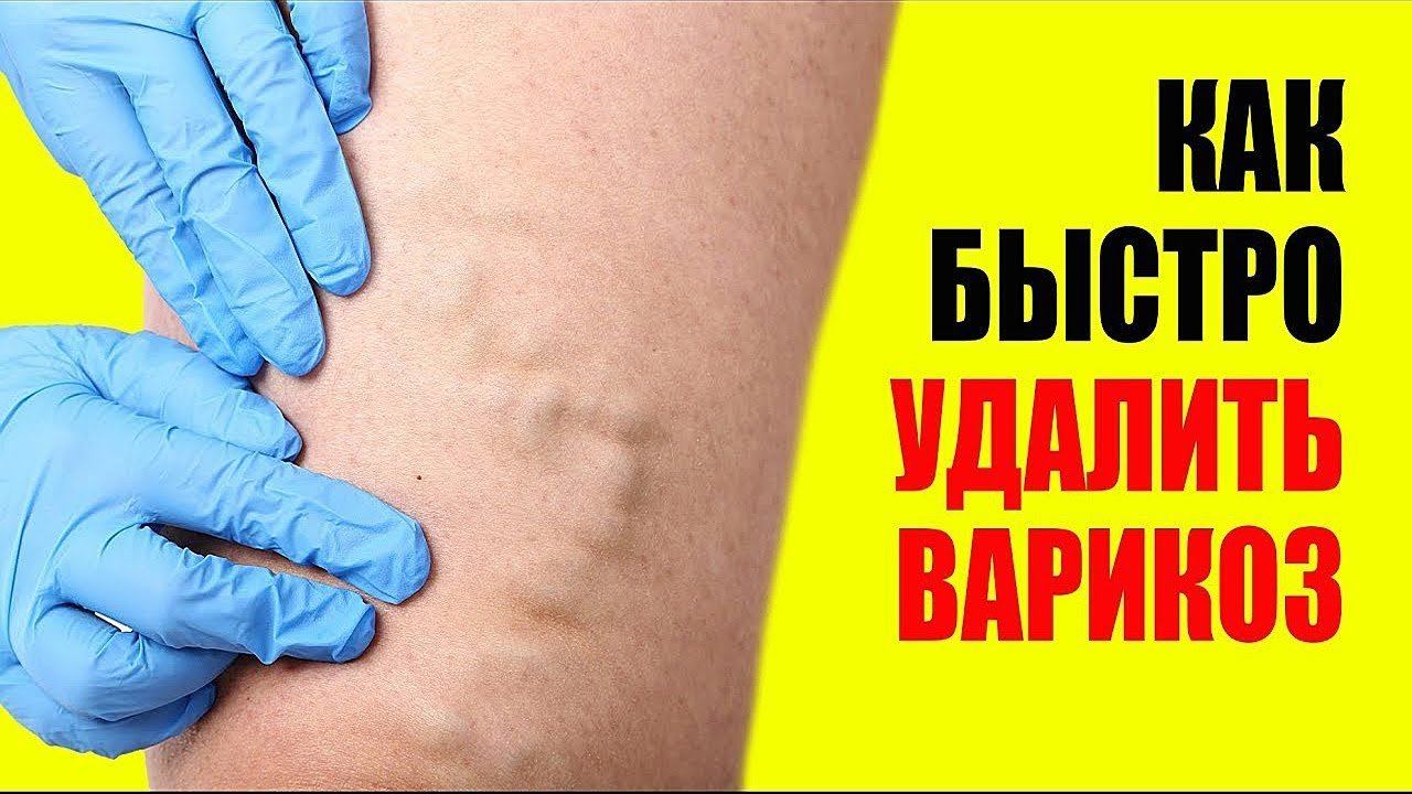 Варикоз на Ногах Лечение. Быстрая Диагностика Варикоза смотреть онлайн