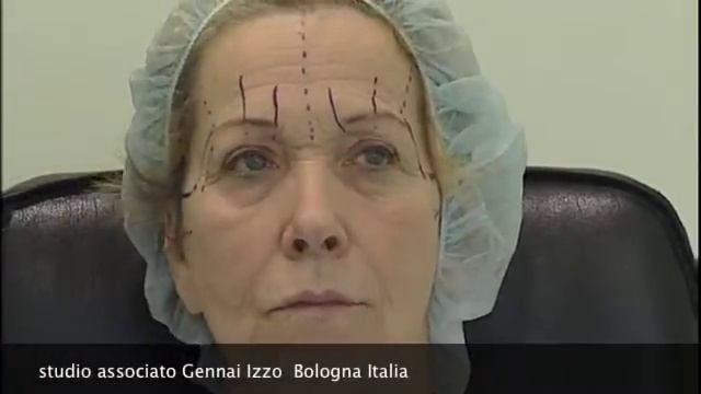 Lifting endoscopico del viso MIVEL: Disegno preoperatorio смотреть онлайн