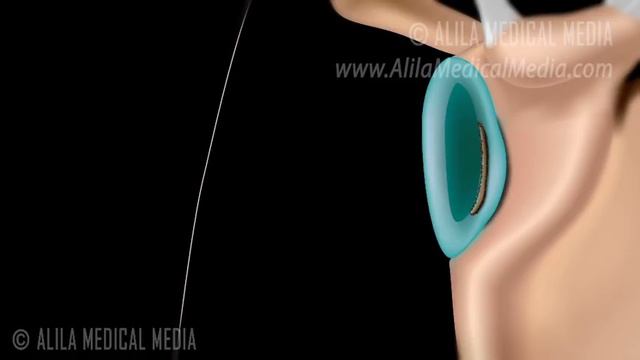 Bankart Lesion and Repair Surgery Animation смотреть онлайн